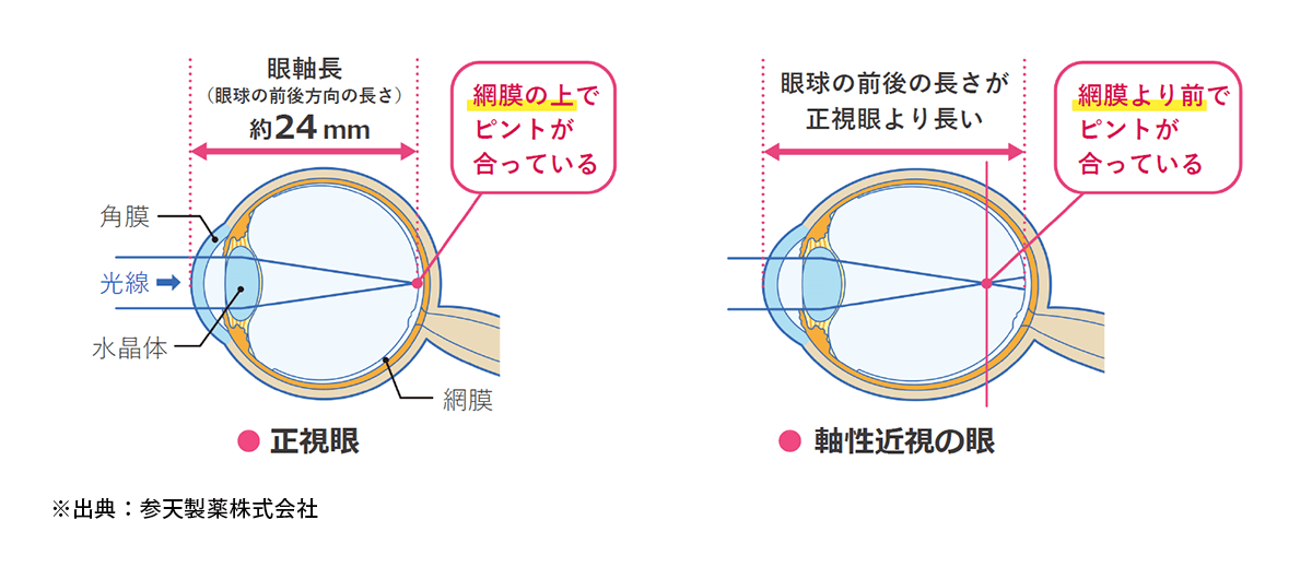子供の近視の進行は目の成長（眼軸の伸長）が原因です