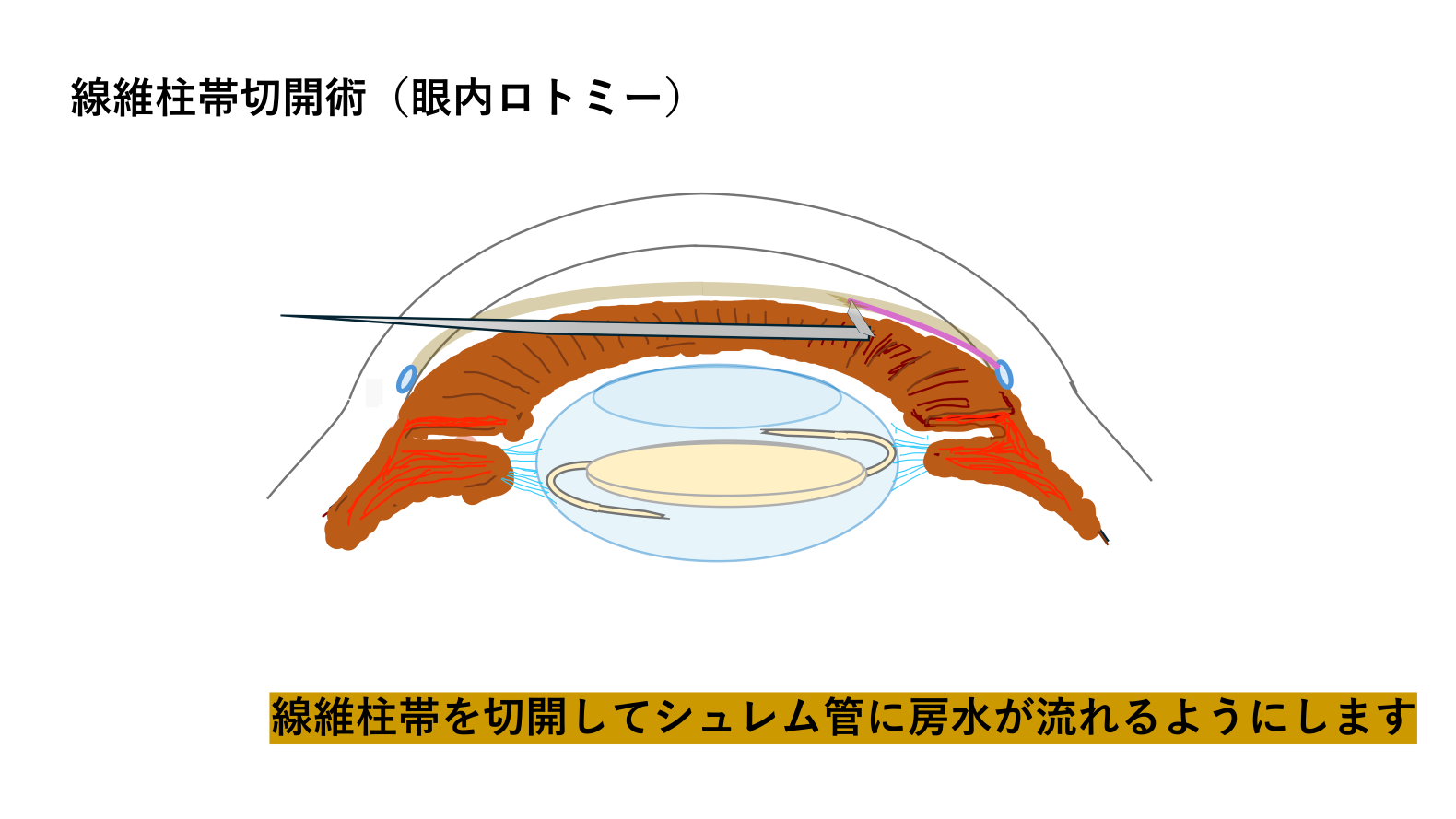 日帰り白内障手術